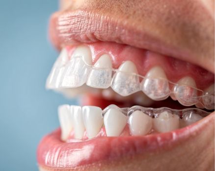 ClearPath Aligners Mysore